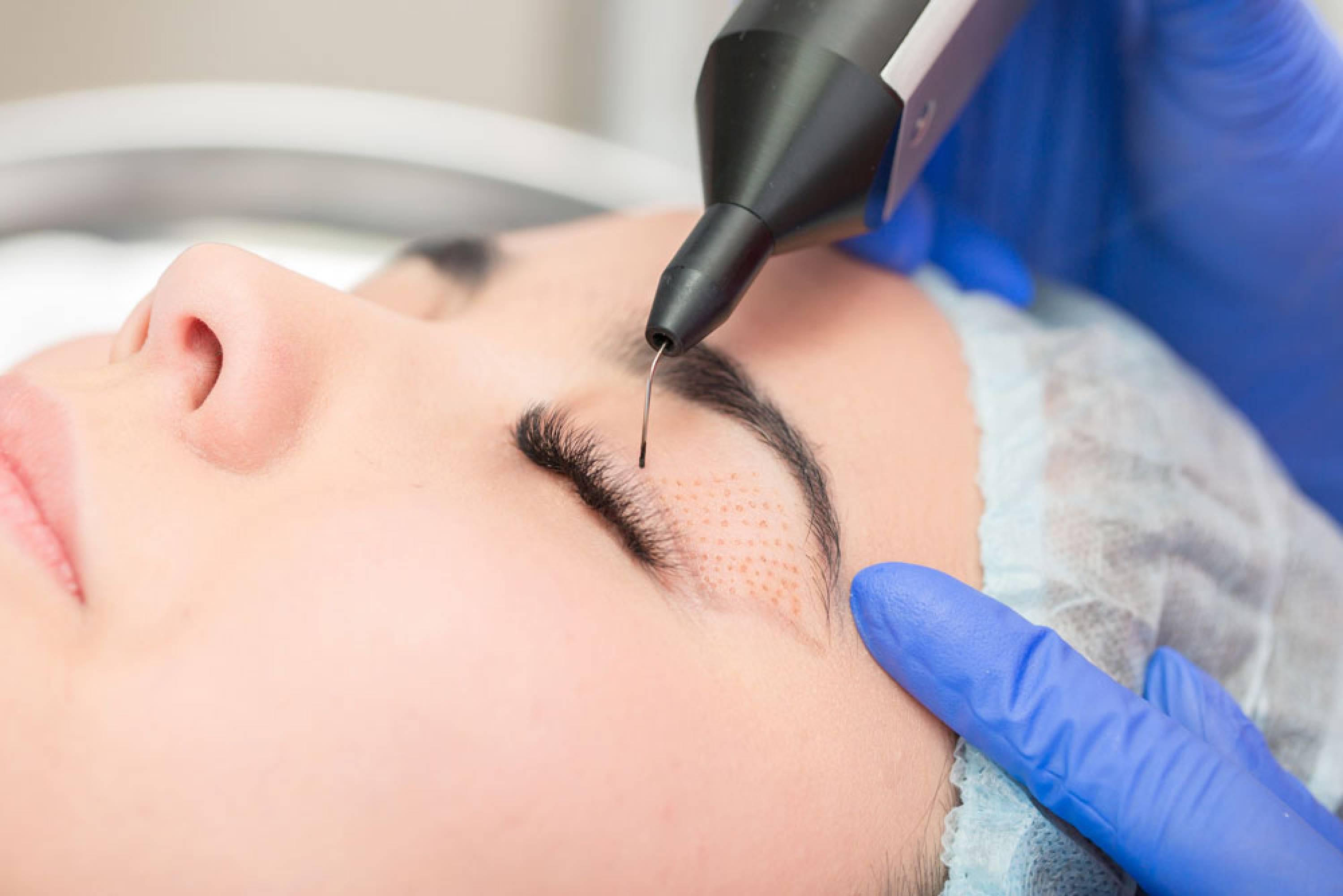 ANAbella Plasma Pen Fibroblast Lidstraffung Lippstadt ANAbella Plasma Pen Fibroblast Lidstraffung Lippstadt